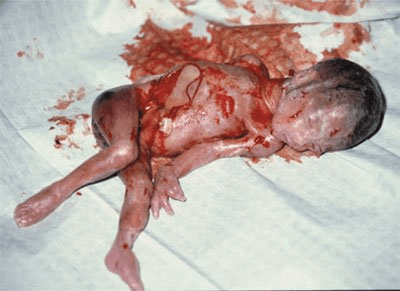 Another victim of partial birth abortion in America